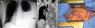 Case reports: a variety of clinical presentations and long-term evolution of Bochdalek hernias